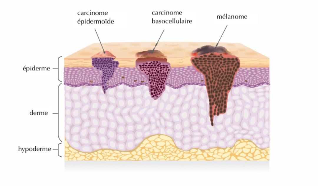 Quelle est la différence entre un carcinome et un mélanome — free download